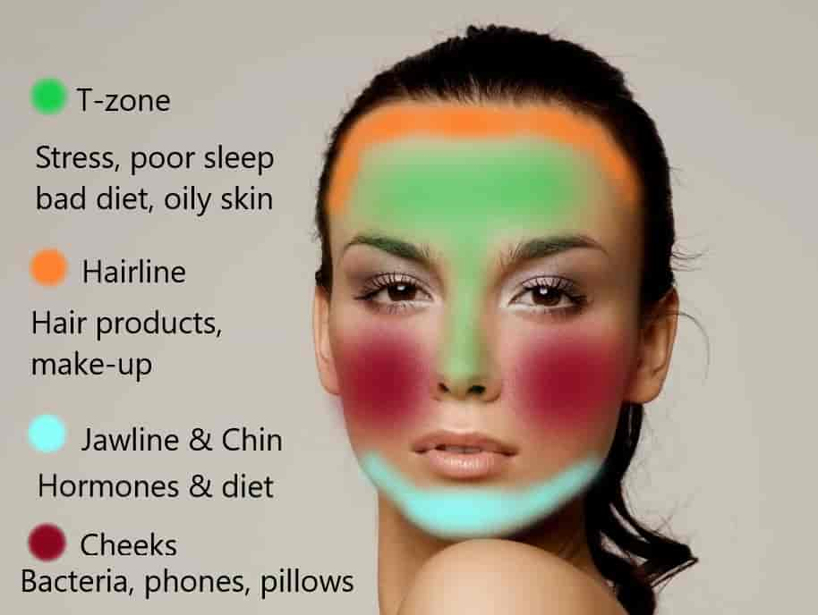 A map covering different areas of the face, and showing what acne spots in each region mean